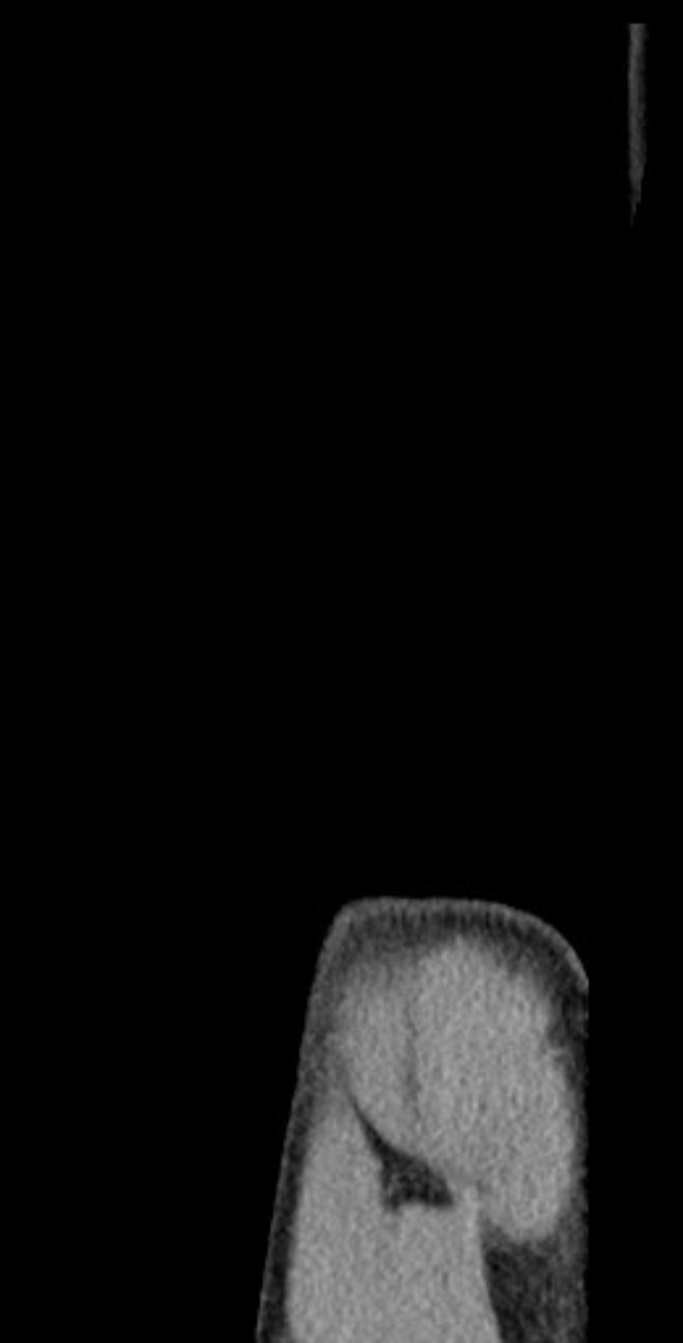 Schwarze und weiße MRI-Aufnahme eines Knies, die detaillierte Knochen- und Weichteilanatomie zeigt.