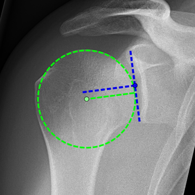 Röntgenbild einer Schulter mit einem grünen Kreis, der ein Ligament in der Mitte markiert, umgeben von anderen Ligamenten.